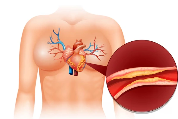 Coronary Angioplasty