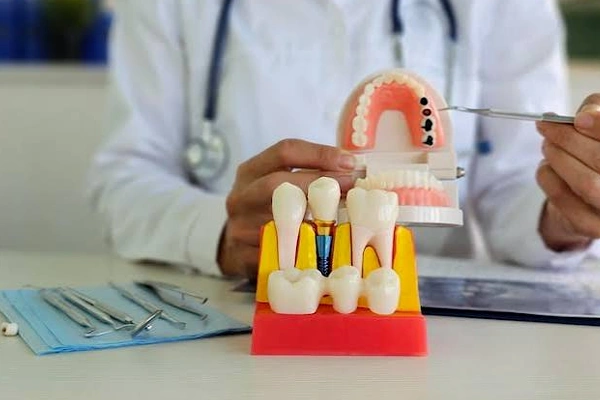 Dental Implants