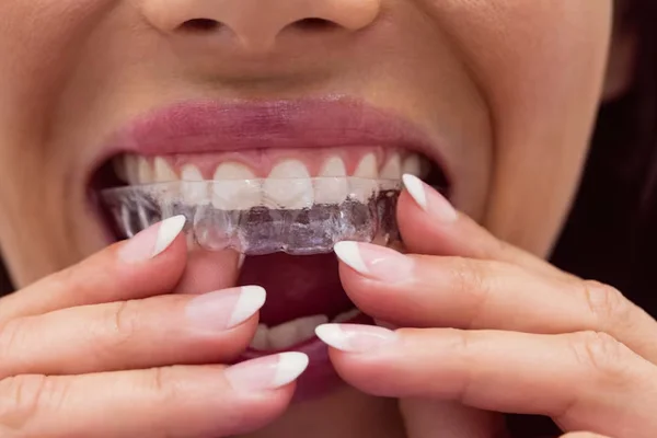 Braces and Aligners